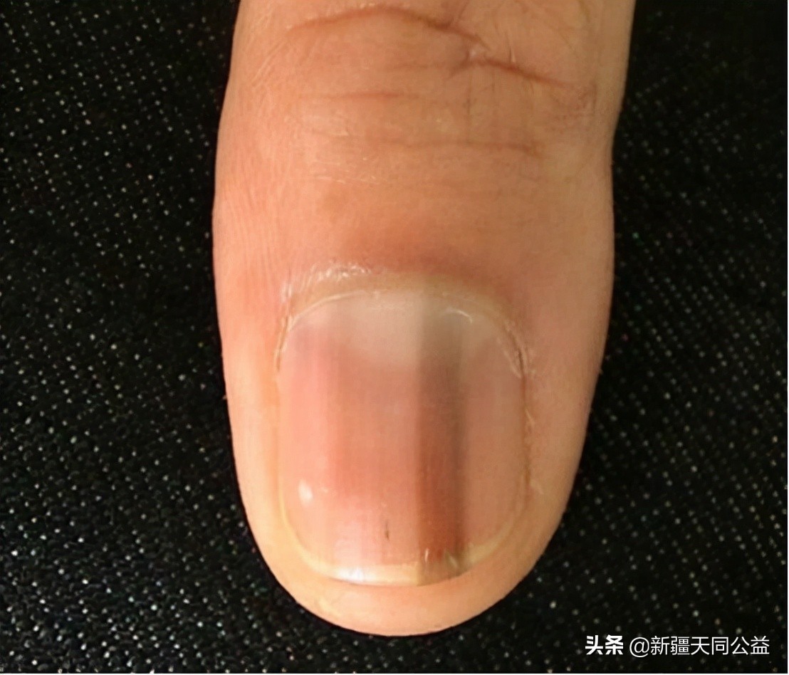 感染艾滋病指甲的变化,艾滋病初期指甲有什么变化