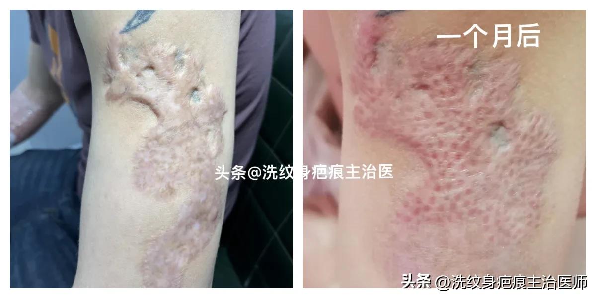 眼袋手术疤痕增生怎么办,剖腹产疤痕增生怎么办