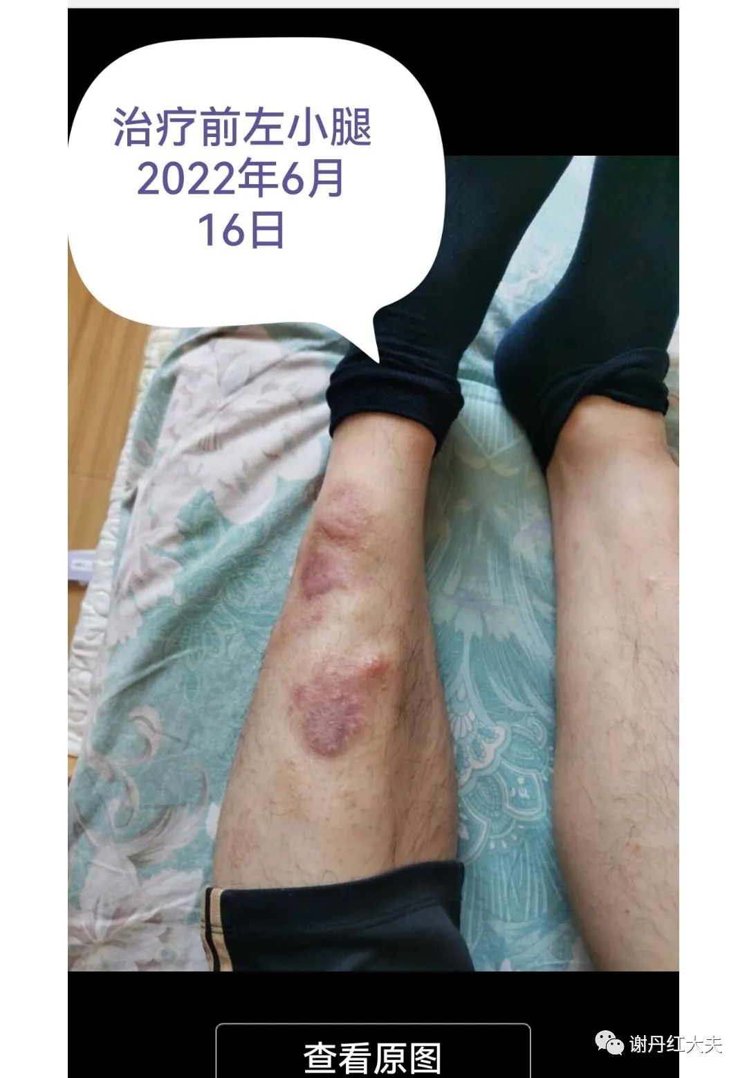 胫前黏液性水肿见于哪些病,胫前黏液性水肿为凹陷性水肿吗