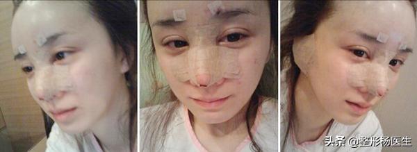 隆鼻怎么做才自然又安全,隆鼻小知识视频