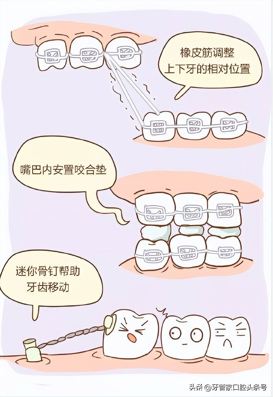 矫正牙齿戴牙套需要注意事项,矫正后戴保持器有什么讲究