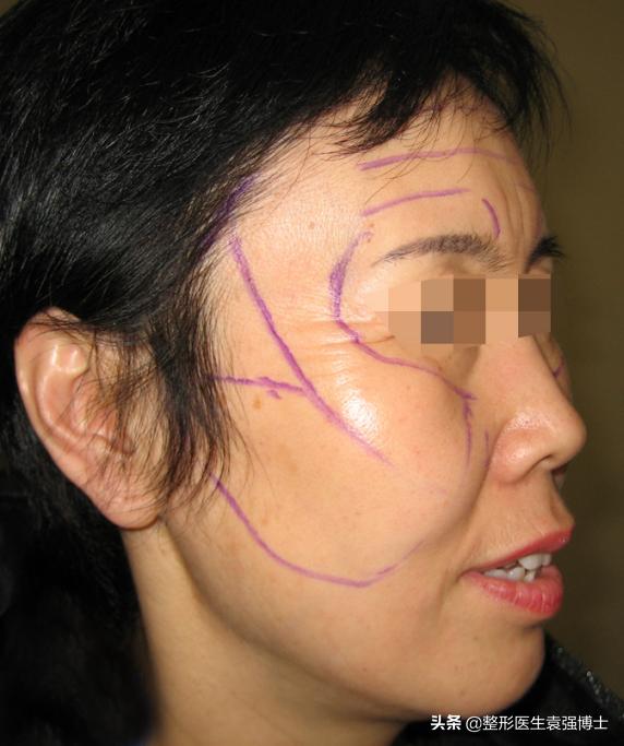 脸下垂松弛提升最好的办法,55岁脸部松弛下垂做什么锻炼紧致