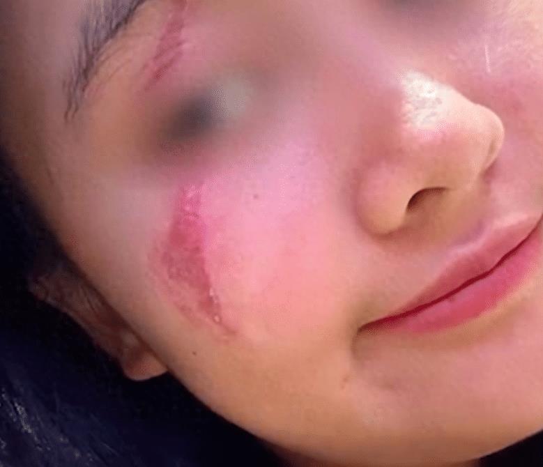 硫酸虫咬了怎么处理,硫酸虫导致皮肤损伤处理