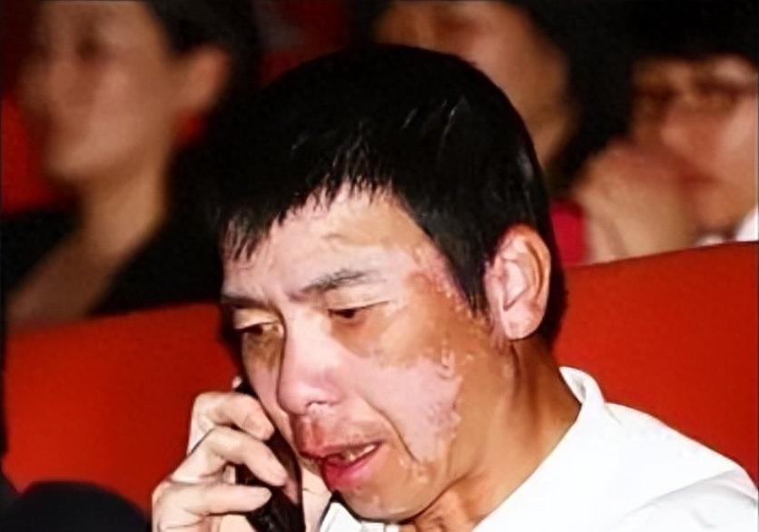 冯小刚的白癜风能治吗,冯小刚患白癜风视频