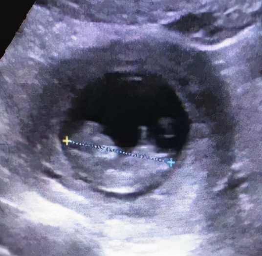 双胞胎隔“宫”相望，医生“攘外安内”