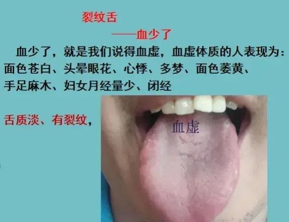 阴虚裂纹舌怎么调理,裂纹舌调理的经历