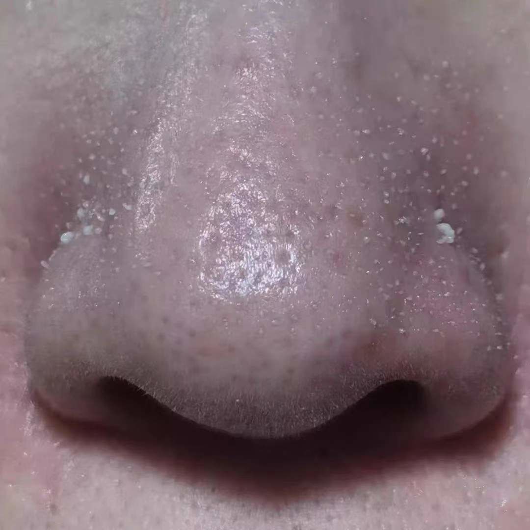 鼻头长黑粉刺怎么回事图片,鼻梁及两侧起了闭口粉刺