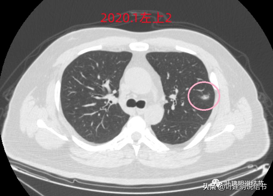 如何判断肺磨玻璃结节是高危结节,肺上有混合磨玻璃结节要注意什么