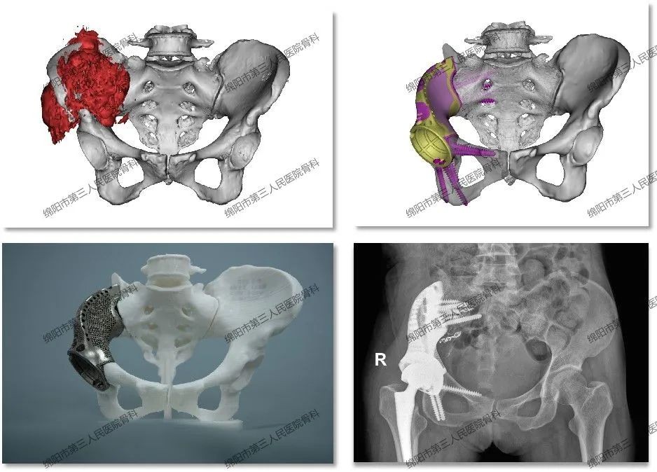 3d打印下颌骨植入手术,3d打印治疗骨肿瘤