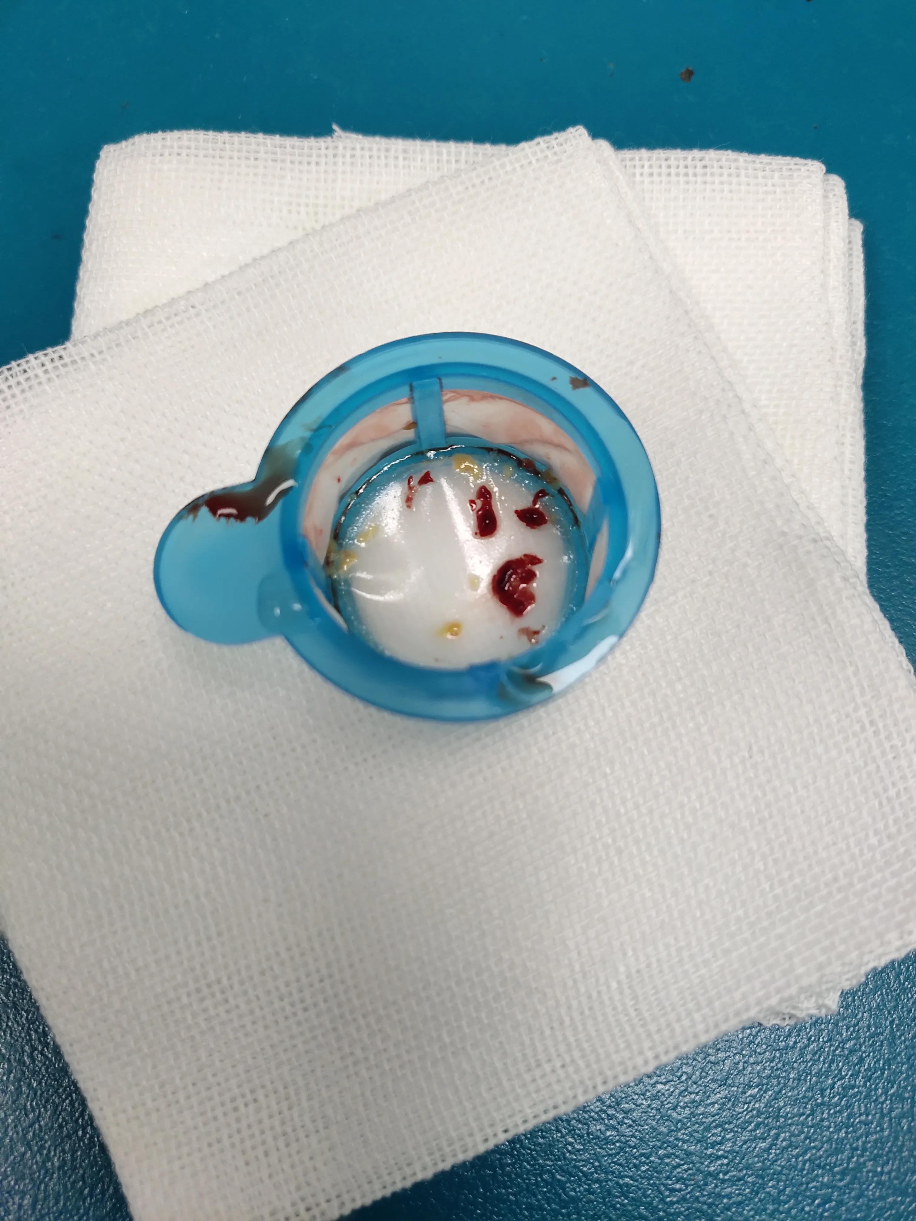 心脏支架后再次出现堵塞,做心脏支架长期服药对胃有影响吗