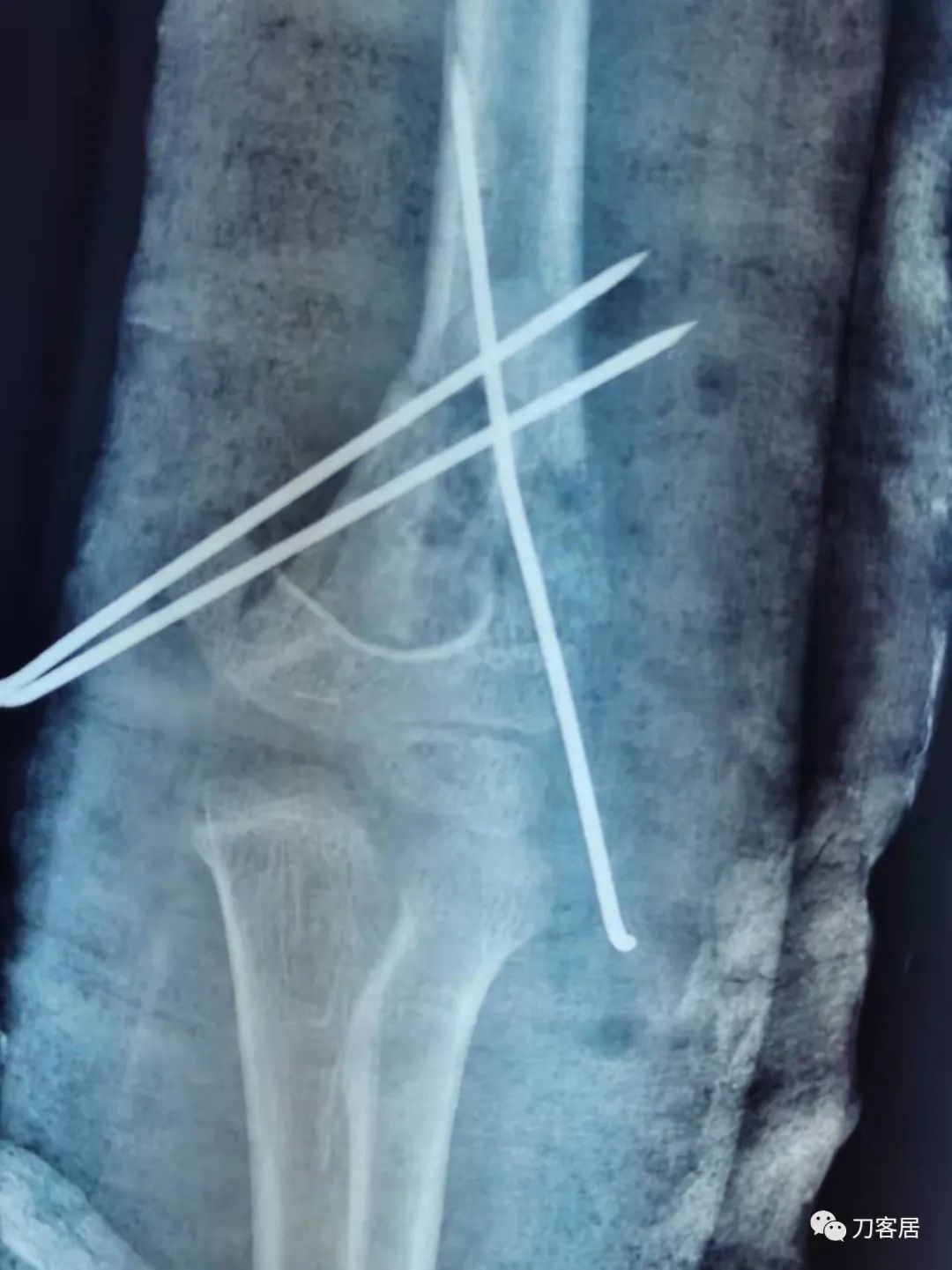 孩子胳膊摔伤肿了不能弯曲一直疼,9岁男孩摔倒手臂痛怎么办