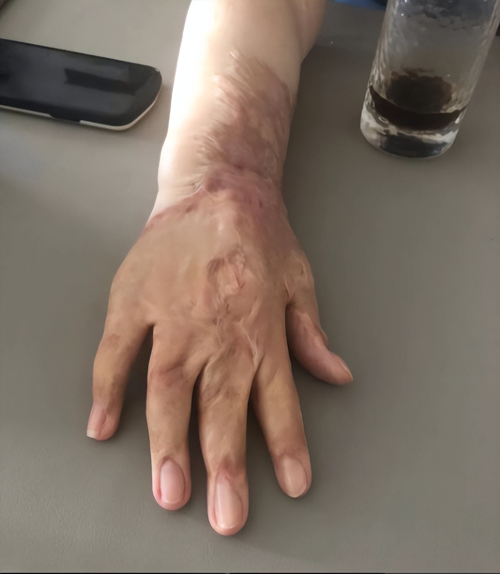 16岁女孩拒绝官二代求爱被毁容,拒绝富二代追求遭毁容以前照片