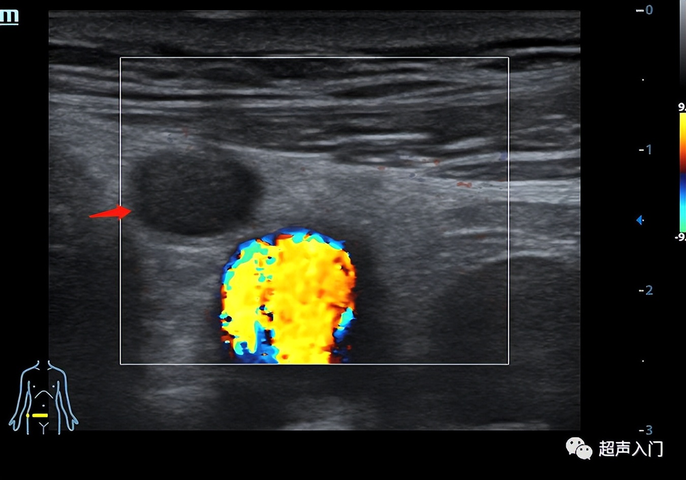 超声介入入门,手把手教你入门超声