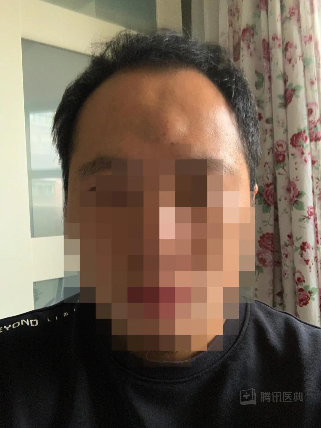 开颅手术后被掀开的头皮多久恢复,开颅手术掀开头皮头皮怎么恢复的