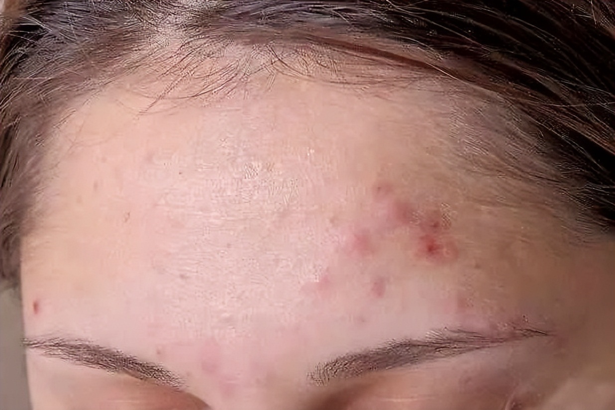 脸上长闭口怎么办小学生,脸上长闭口怎么办