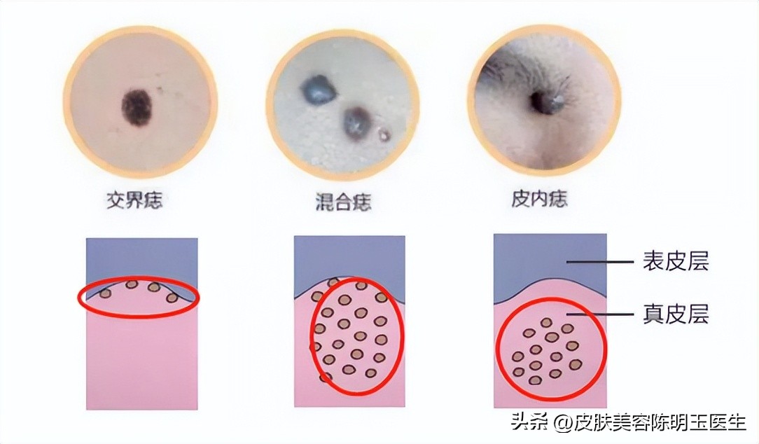 祛痣有什么讲究,怎么点痣好祛痣的方法有哪些