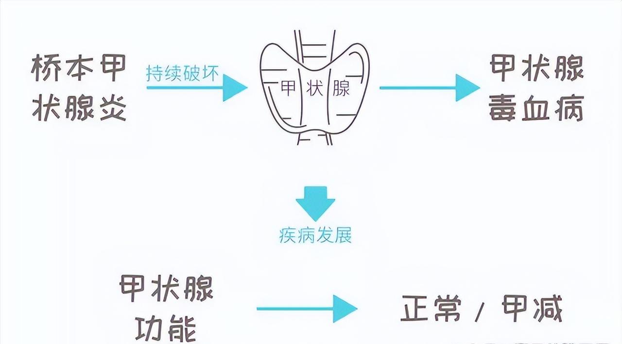 16岁女孩桥本氏甲状腺炎治疗,14岁女孩桥本甲状腺炎能治愈吗