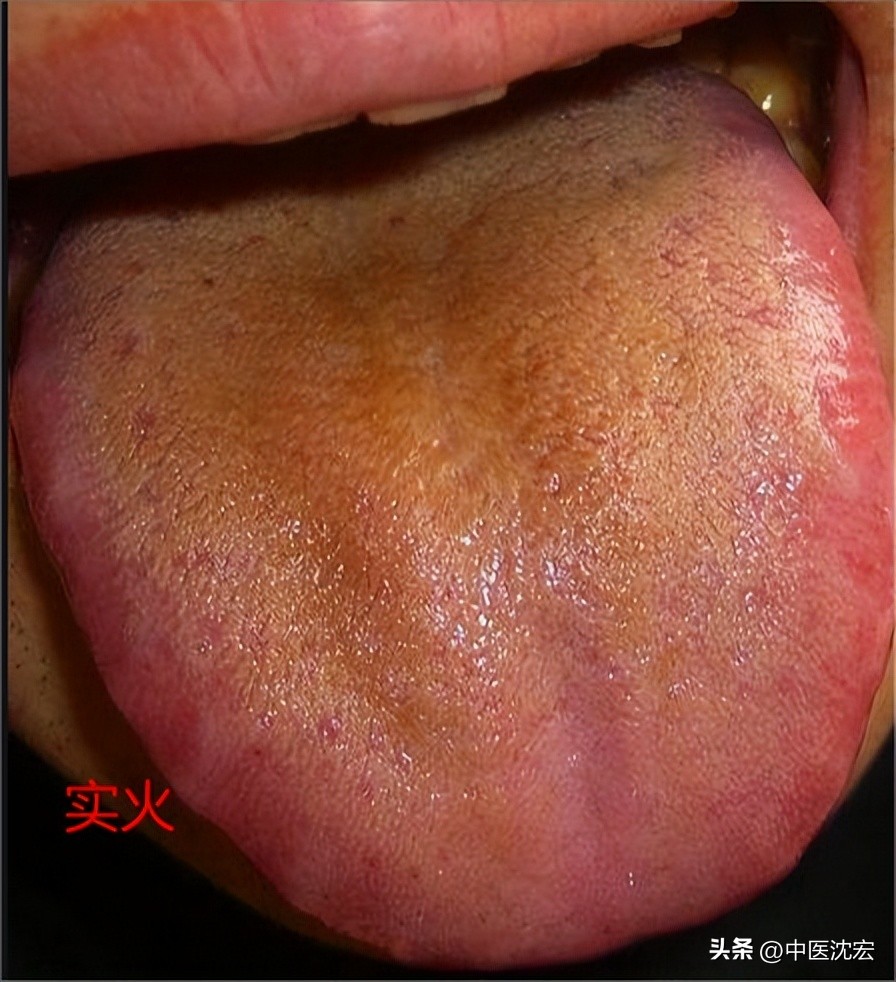 舌红舌头胖,舌暗红但舌苔很白是寒是热