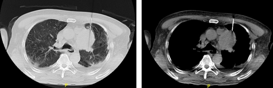 全身肌肉酸痛无力发软是甲流吗,前上纵隔见团块状软组织密度影