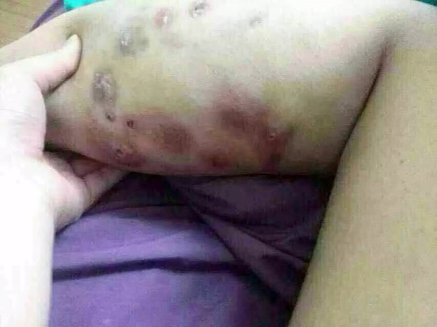 注射完后针眼溃烂怎么办,注射后针孔发炎怎么处理