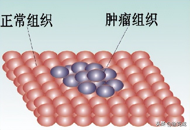 徐克成大讲堂,徐克成谈癌症克星