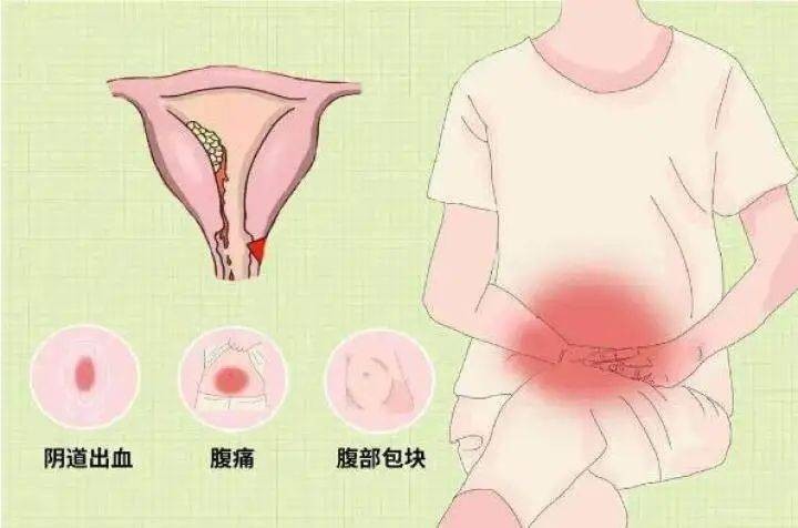 妇科恶性肿瘤一来，就会给出3个“危险信号”，要留心