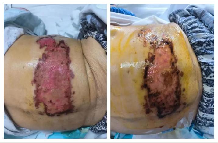 老人得过疱疹后总感冒,老年人得了疱疹多久可以自愈