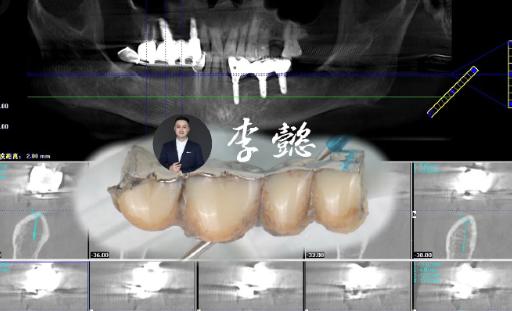 种植牙之前你一定要搞清楚这7件事？