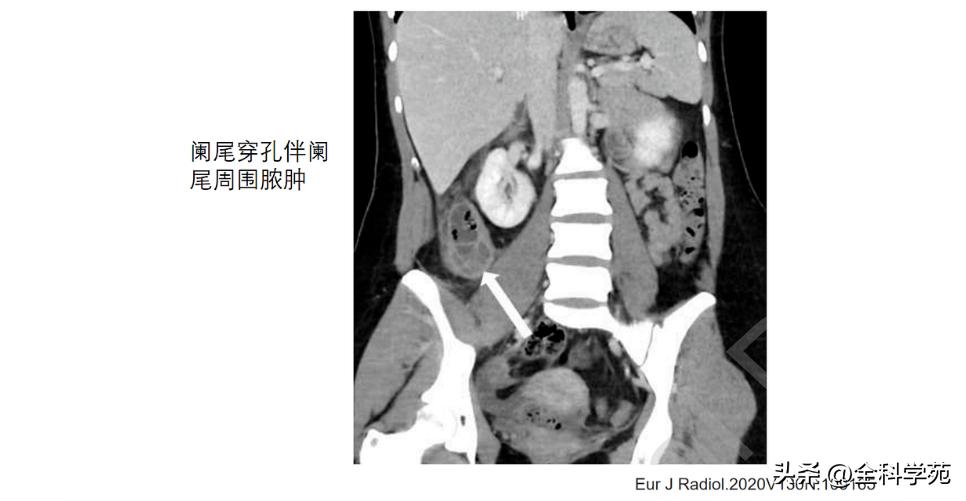 阑尾炎的讲解,关于阑尾炎的讨论总结