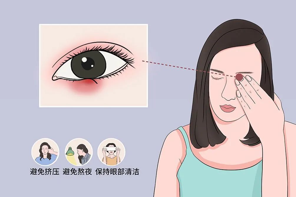 又长麦粒肿了,又长麦粒肿还长火疖子怎么回事