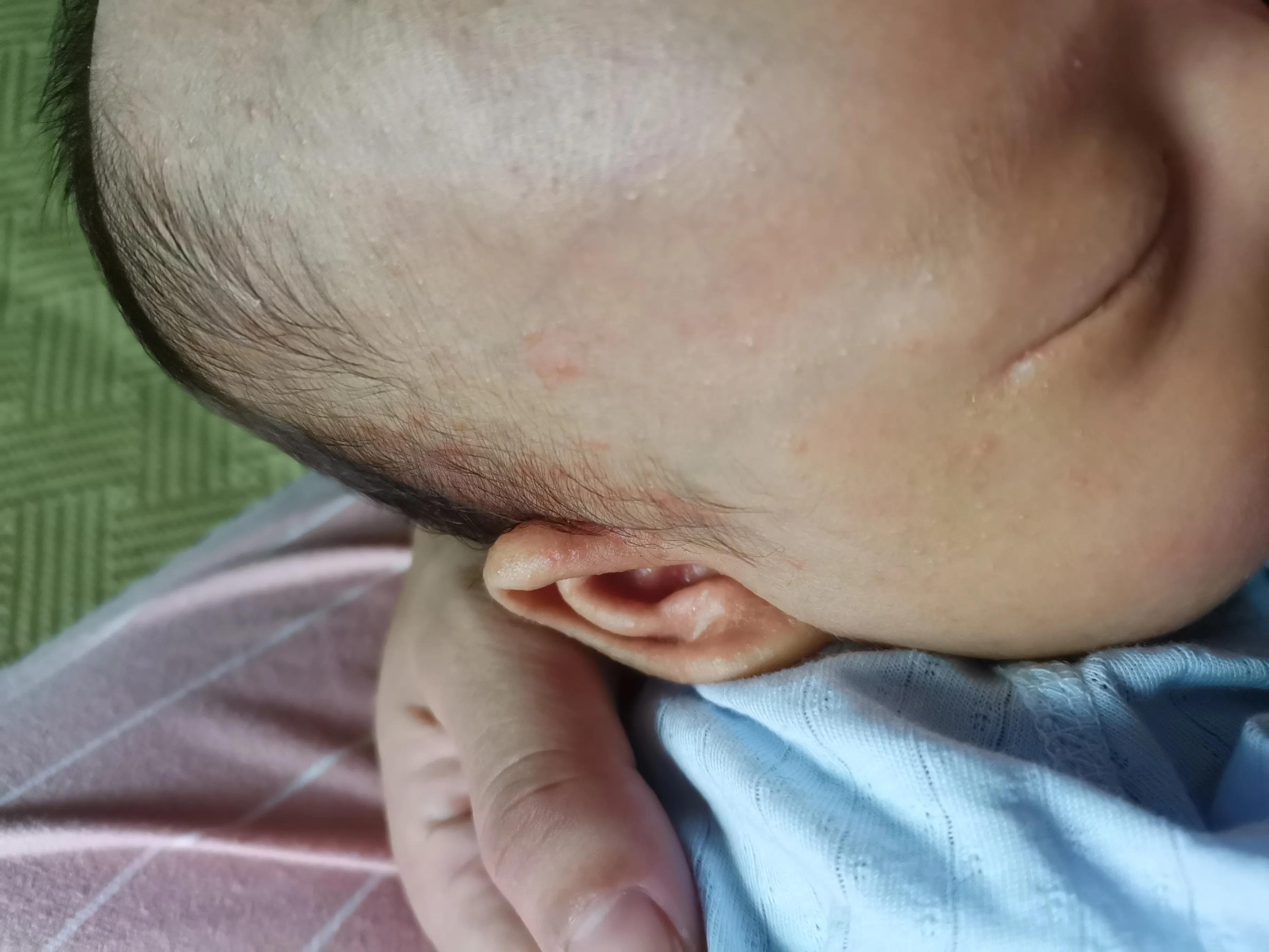 南方孩子长湿疹,南方的婴儿容易出湿疹吗