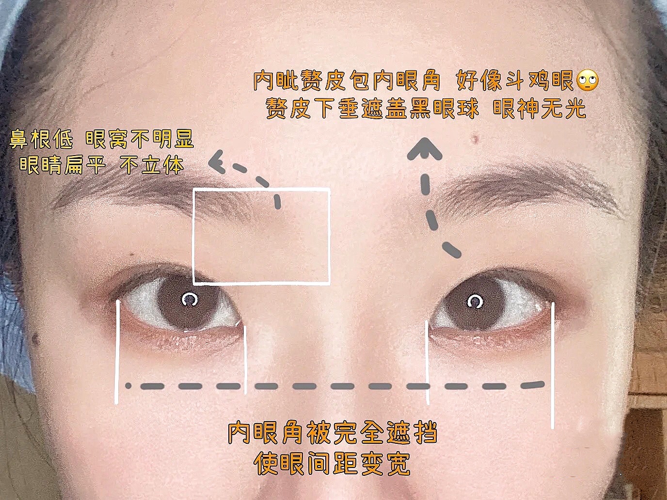 整形科普知识修复双眼皮,双眼皮整形有哪些常见方法