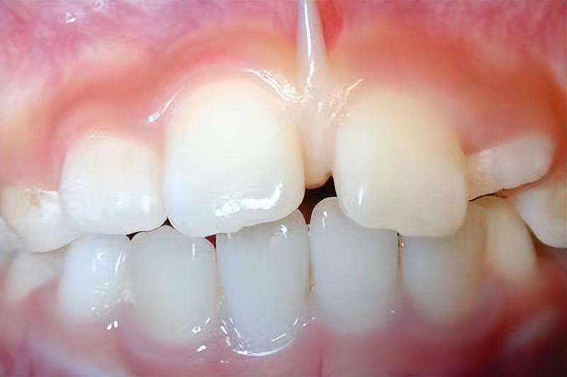 宝宝牙缝有点大这是好还是坏呢,为什么宝宝的牙缝很大