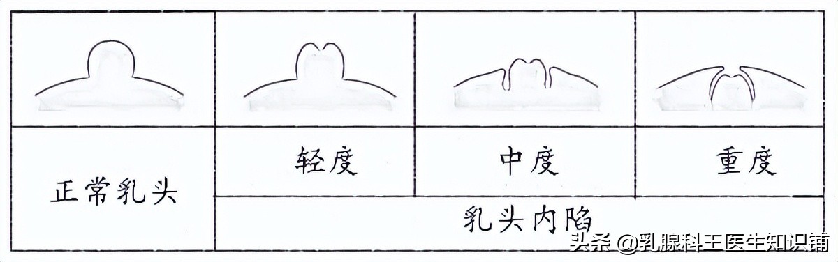 你必须知道！原来“乳头内陷”的危害这么大