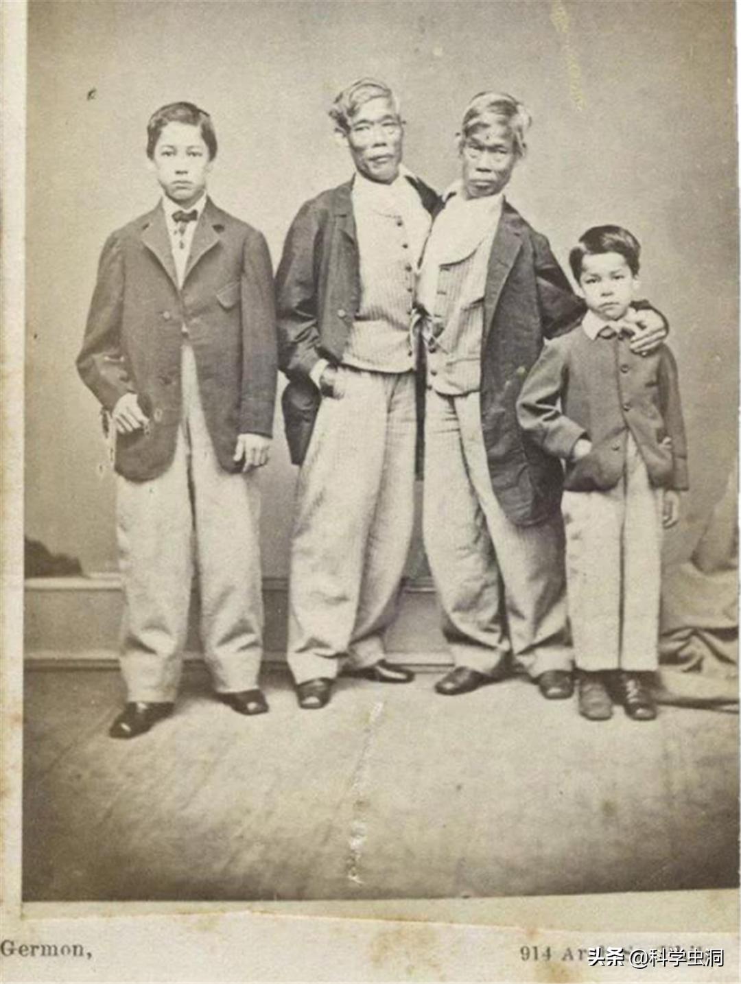 连体姐妹其中一个人死了怎么办,连体姐妹一个死了另一个咋办