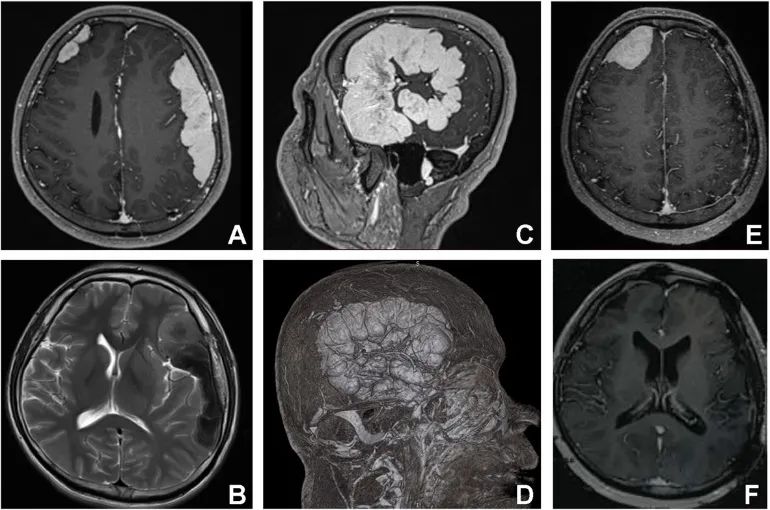 星闻丨领星携手中山一院金华伟教授团队探索中枢神经系统罗道病