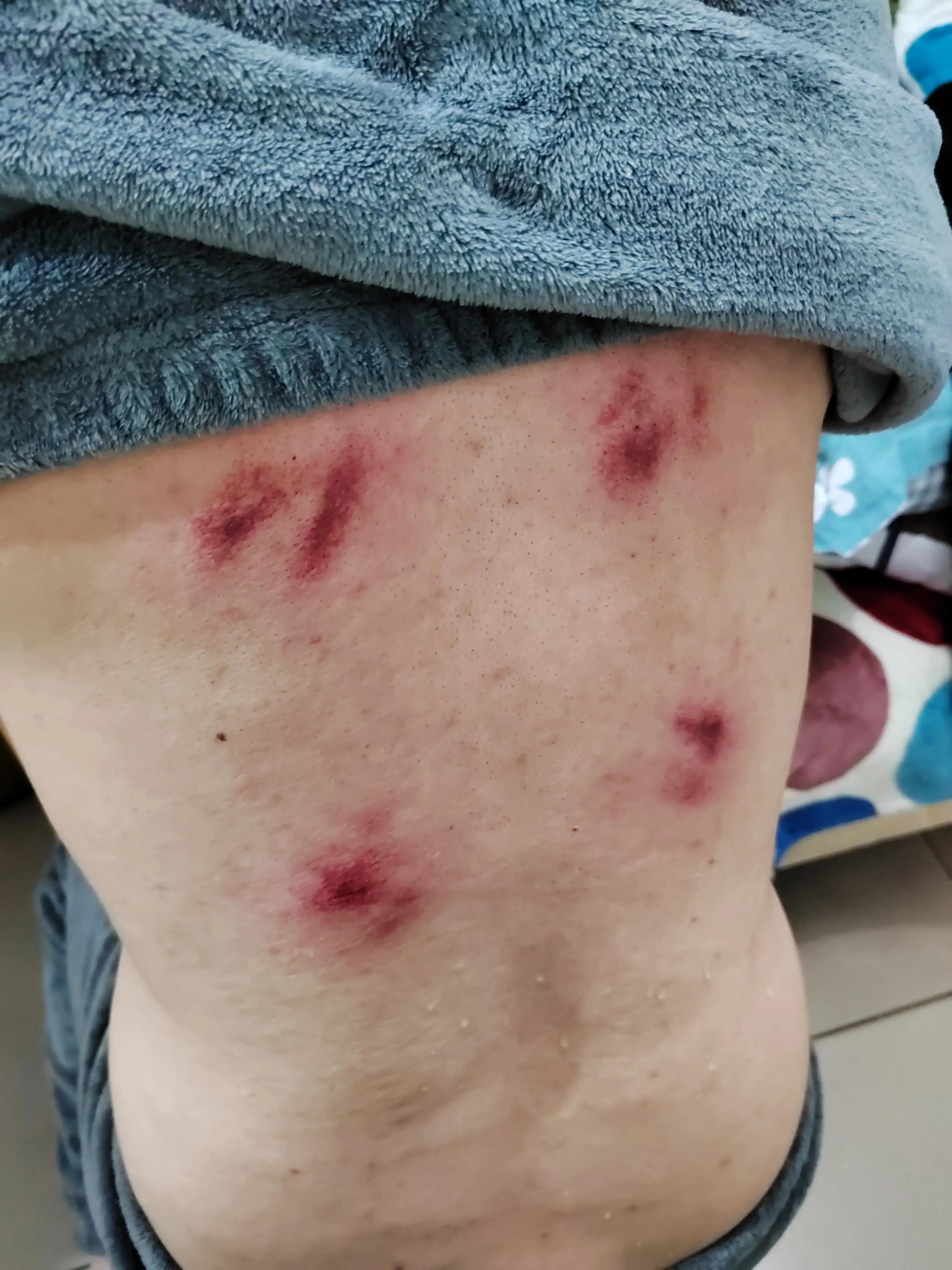 小孩怎样物理退烧,物理退烧适合低烧还是高烧