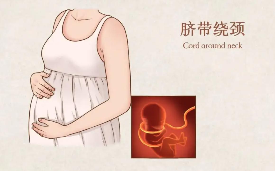 33周胎儿脐带绕颈一周能绕回来吗,胎儿脐带绕颈的原因和解决方法