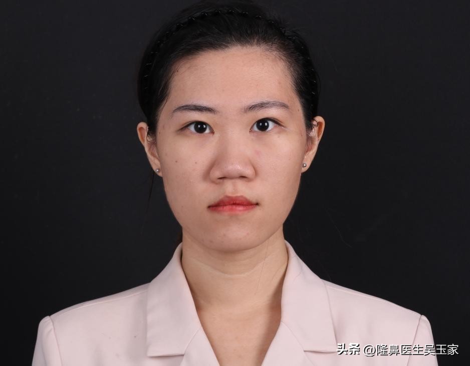 一个人，大老远的从外地跑到北京，只做“鼻翼缩小”，值不值？