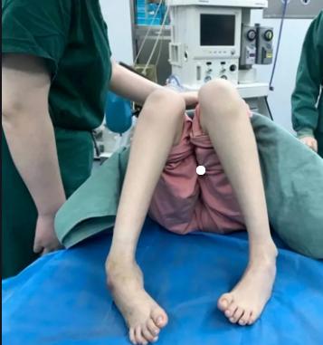 先天性马蹄足,先天性马蹄足矫形方法