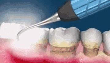 牙齿松动医生说周围没骨头怎么办,牙齿发黑断裂松动医生建议拔掉