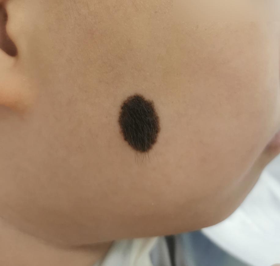 黑毛痣去掉还会长毛吗,黑毛痣到哪里可以去掉