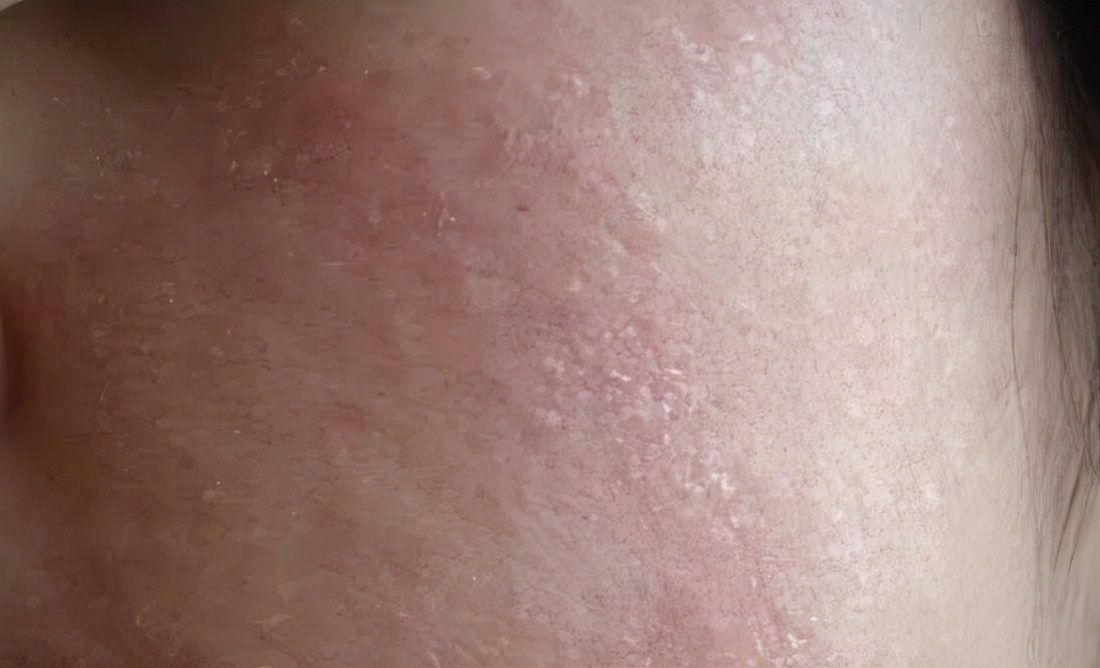 皮肤干燥刺痛用什么护肤品,脱皮刺痛泛红用什么护肤品