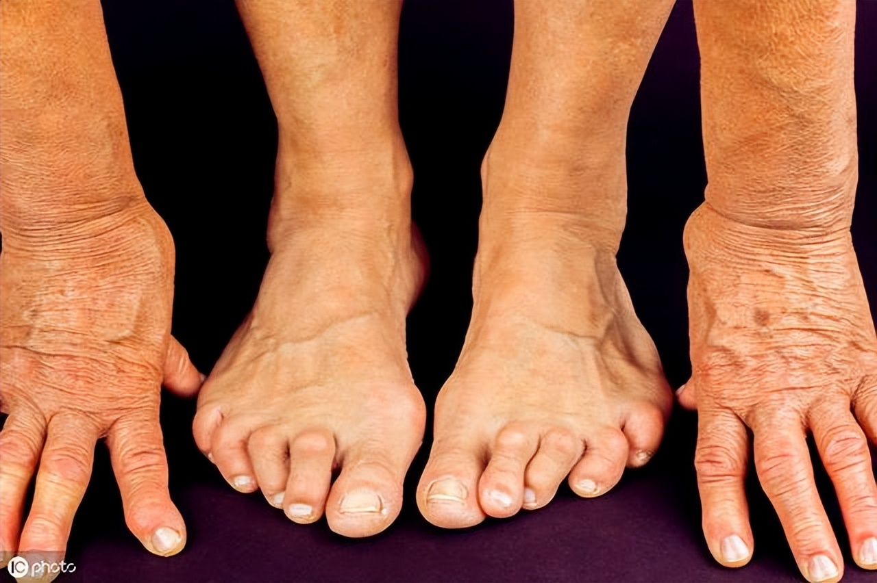 有没有2型糖尿病根治的办法,有糖尿病和风湿病该怎么调理