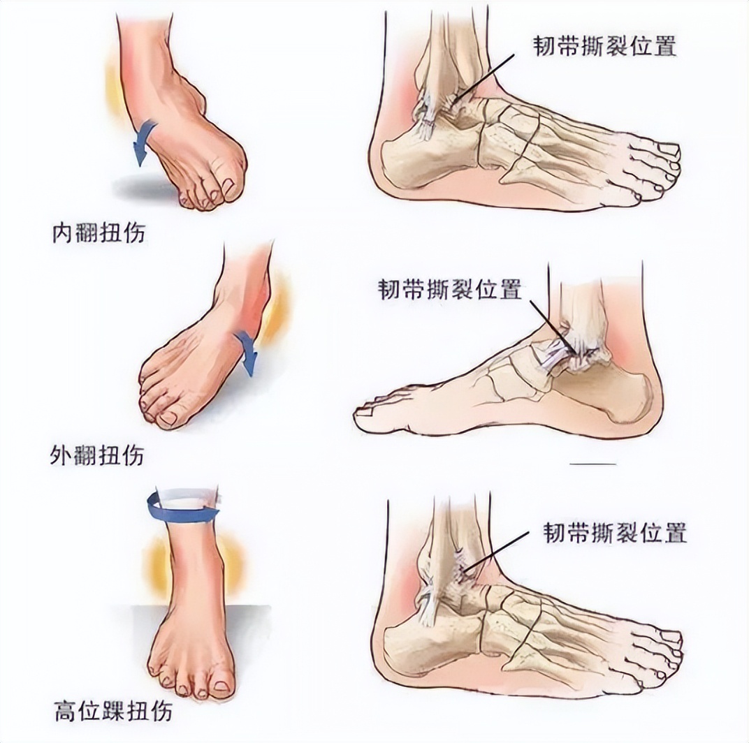 踝关节康复斜板站立训练方法,如何锻炼韧带保证踝关节稳定性