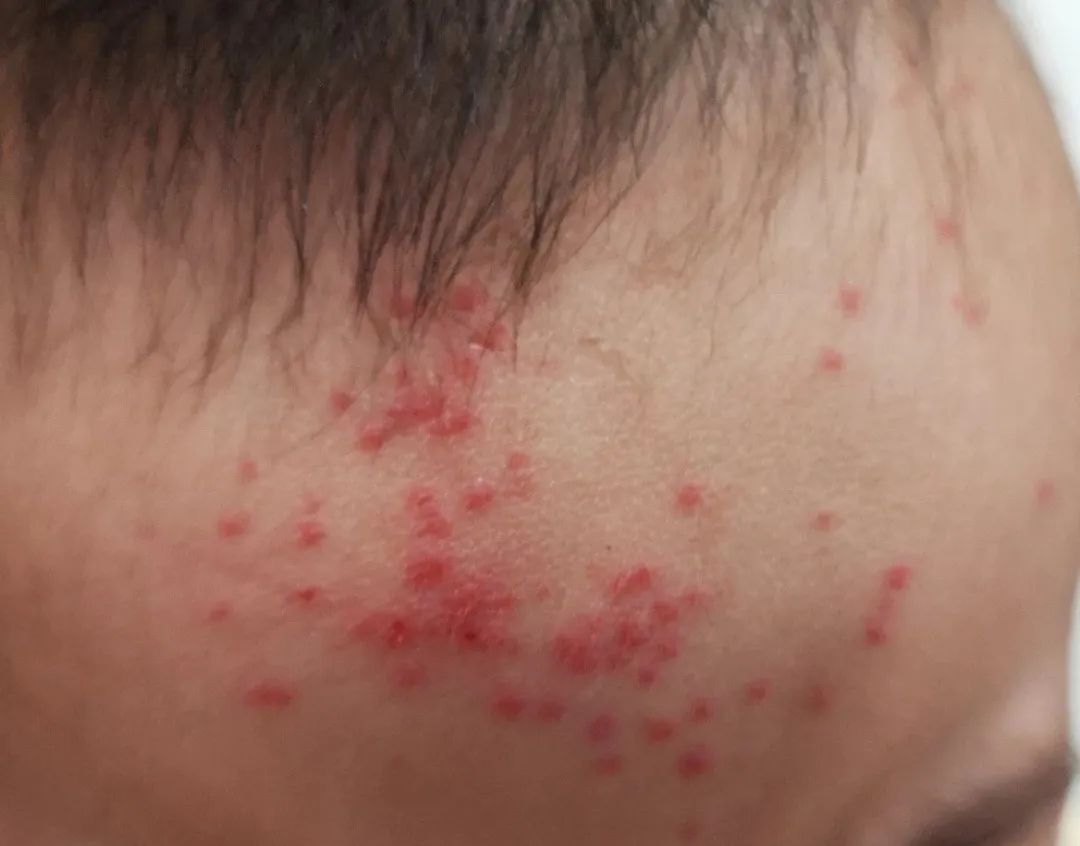 新冠后长了病毒疹,新冠阳性后皮肤长疹子