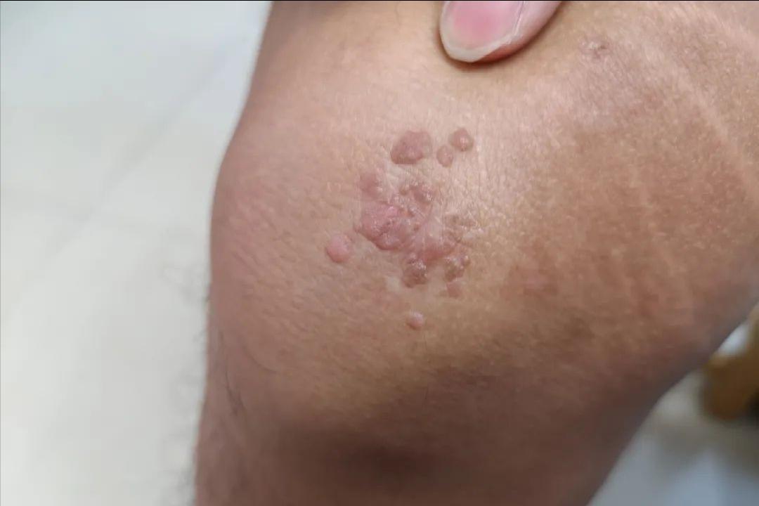 hpv和疣是一种病吗,hpv病毒疣是什么样的