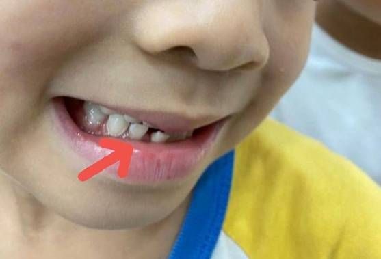 地包天矫正越早越好吗,地包天矫正到什么程度需要拔牙