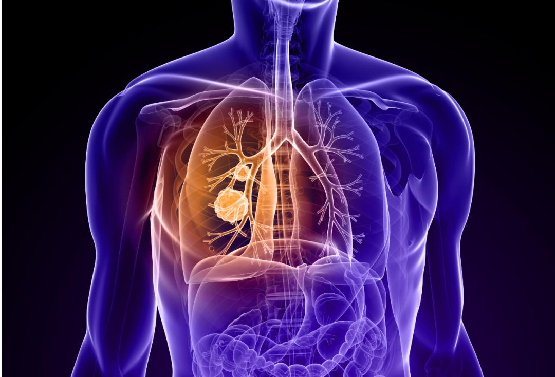 查出一个肺小结节很焦虑,查出肺结节这2件事您必须要知道