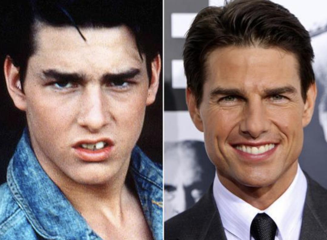 整牙亲身经历分享一下,整牙的经历分享